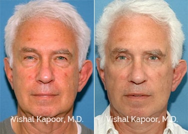 Patient 03 Front View Face Neck Rejuvenation Beverly Hills Cosmetic Plastic Surgery Doc