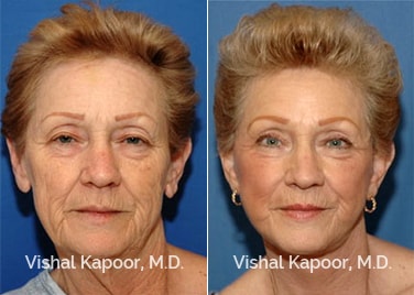 Patient 04 Front View Face Neck Rejuvenation Beverly Hills Cosmetic Plastic Surgery Doc