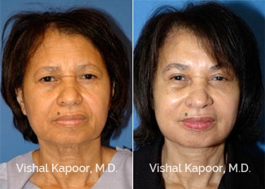 Patient 06 Front View Face Neck Rejuvenation Beverly Hills Cosmetic Plastic Surgery Doc