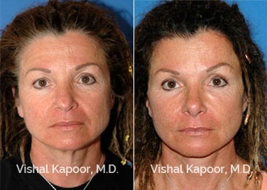 Patient 11 Front View Face Neck Rejuvenation Beverly Hills Cosmetic Plastic Surgery Doc
