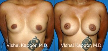 Patient 24 Front View Breast Augmentation Beverly Hills Cosmetic Plastic Surgery Doc