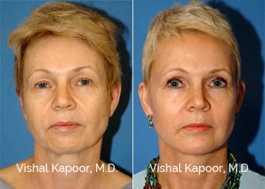 Patient 05 Front View Eyelid Surgery Beverly Hills Cosmetic Plastic Surgery Doc