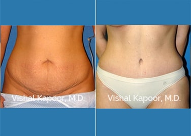 Patient 12 Front View Liposuction Beverly Hills Cosmetic Plastic Surgery Doc