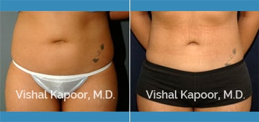 Patient 15 Front View Liposuction Beverly Hills Cosmetic Plastic Surgery Doc