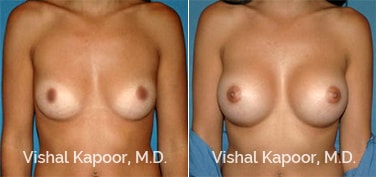Patient 46 Front View Breast Augmentation Beverly Hills Cosmetic Plastic Surgery Doc