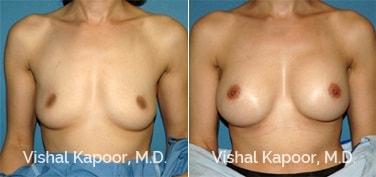 Patient 56 Front View Breast Augmentation Beverly Hills Cosmetic Plastic Surgery Doc