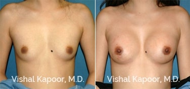 Patient 61 Front View Breast Augmentation Beverly Hills Cosmetic Plastic Surgery Doc