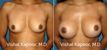 Patient 64 Front View Breast Augmentation Beverly Hills Cosmetic Plastic Surgery Doc