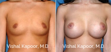 Patient 66 Front View Breast Augmentation Beverly Hills Cosmetic Plastic Surgery Doc