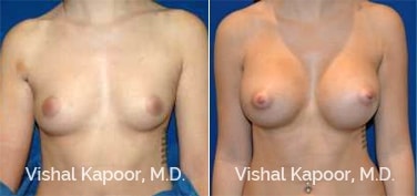 Patient 72 Front View Breast Augmentation Beverly Hills Cosmetic Plastic Surgery Doc