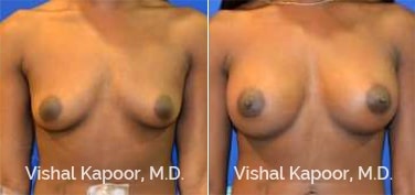 Patient 73 Front View Breast Augmentation Beverly Hills Cosmetic Plastic Surgery Doc