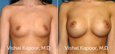 Patient 84 Front View Breast Augmentation Beverly Hills Cosmetic Plastic Surgery Doc