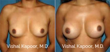 Patient 85 Front View Breast Augmentation Beverly Hills Cosmetic Plastic Surgery Doc