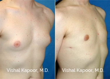 Patient 04 3/4 View Male Breast Reduction Beverly Hills Cosmetic Plastic Surgery Doc