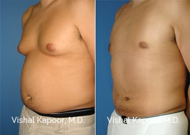 Patient 01 3/4 View Liposuction Beverly Hills Cosmetic Plastic Surgery Doc