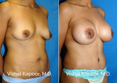 Patient 04 3/4 View Liposuction Beverly Hills Cosmetic Plastic Surgery Doc