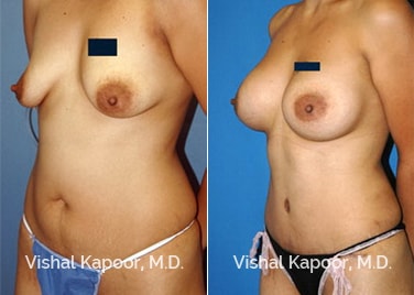 Patient 05 3/4 View Liposuction Beverly Hills Cosmetic Plastic Surgery Doc