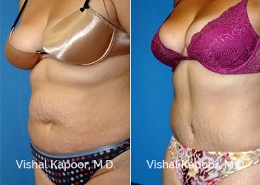 Patient 07 3/4 View Liposuction Beverly Hills Cosmetic Plastic Surgery Doc