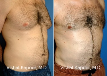 Patient 08 3/4 View Liposuction Beverly Hills Cosmetic Plastic Surgery Doc