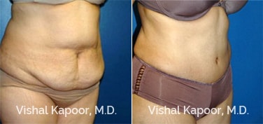 Patient 13 3/4 View Liposuction Beverly Hills Cosmetic Plastic Surgery Doc