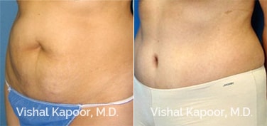 Patient 14 3/4 View Liposuction Beverly Hills Cosmetic Plastic Surgery Doc