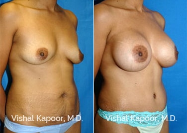 Patient 01 3/4 View Tummy Tuck Beverly Hills Cosmetic Plastic Surgery Doc