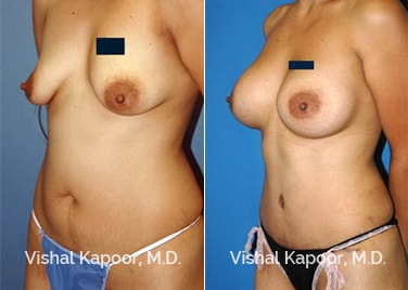 Patient 02 3/4 View Tummy Tuck Beverly Hills Cosmetic Plastic Surgery Doc