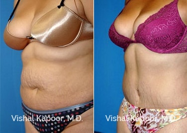 Patient 04 3/4 View Tummy Tuck Beverly Hills Cosmetic Plastic Surgery Doc