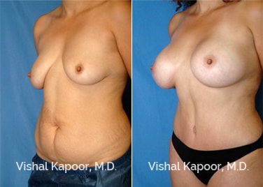 Patient 05 3/4 View Tummy Tuck Beverly Hills Cosmetic Plastic Surgery Doc