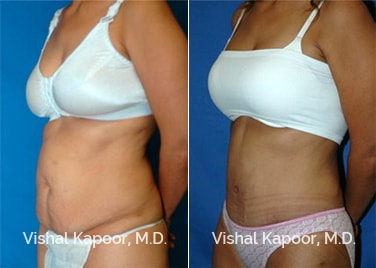 Patient 07 3/4 View Tummy Tuck Beverly Hills Cosmetic Plastic Surgery Doc
