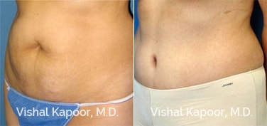 Patient 13 3/4 View Tummy Tuck Beverly Hills Cosmetic Plastic Surgery Doc