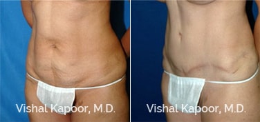 Patient 16 3/4 View Tummy Tuck Beverly Hills Cosmetic Plastic Surgery Doc
