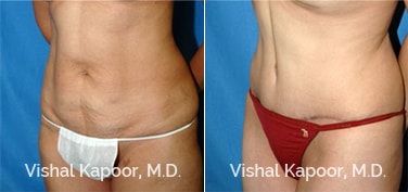 Patient 17 3/4 View Tummy Tuck Beverly Hills Cosmetic Plastic Surgery Doc
