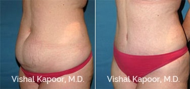 Patient 20 3/4 View Tummy Tuck Beverly Hills Cosmetic Plastic Surgery Doc