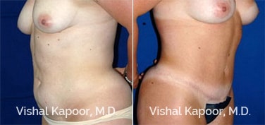 Patient 21 3/4 View Tummy Tuck Beverly Hills Cosmetic Plastic Surgery Doc