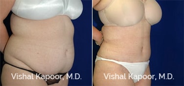 Tummy Tuck Surgery Patient 22 Beverly Hills shows the vast improvement in aesthetics