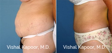 Patient 23 Side View Tummy Tuck Beverly Hills Cosmetic Plastic Surgery Doc