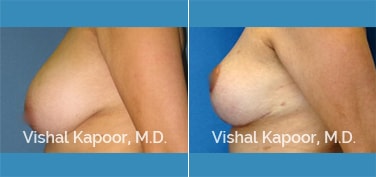 Patient 01 Side View Breast Reduction Beverly Hills Cosmetic Plastic Surgery Doc