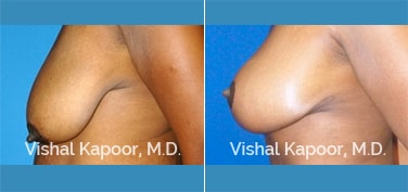 Patient 02 Side View Breast Reduction Beverly Hills Cosmetic Plastic Surgery Doc