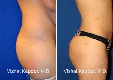 Patient 01 Right Side View Brazilian Butt Lift Beverly Hills Cosmetic Plastic Surgery Doc
