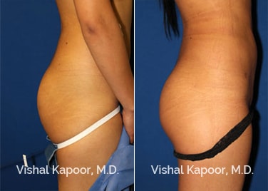 Patient 02 Right Side View Brazilian Butt Lift Beverly Hills Cosmetic Plastic Surgery Doc