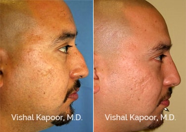 Patient 02 Left View Revision Rhinoplasty Beverly Hills Cosmetic Plastic Surgery Doc