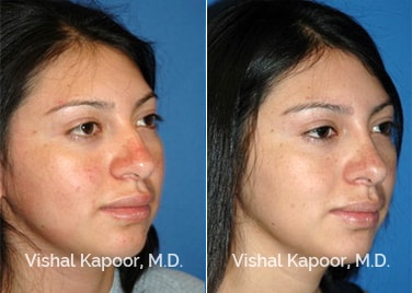 Patient 04 3/4 View Revision Rhinoplasty Beverly Hills Cosmetic Plastic Surgery Doc