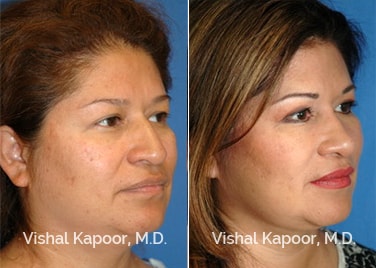 Patient 07 3/4 View Revision Rhinoplasty Beverly Hills Cosmetic Plastic Surgery Doc