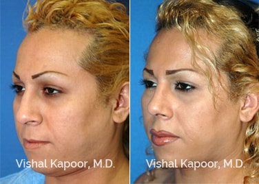 Patient 08 3/4 View Revision Rhinoplasty Beverly Hills Cosmetic Plastic Surgery Doc