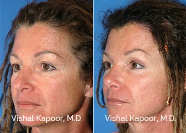 Patient 09 3/4 View Revision Rhinoplasty Beverly Hills Cosmetic Plastic Surgery Doc