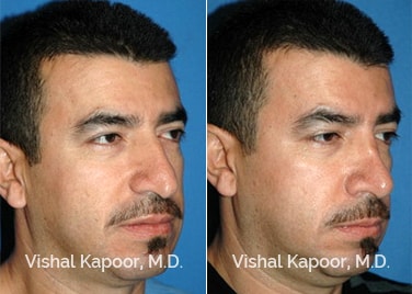 Patient 10 3/4 View Revision Rhinoplasty Beverly Hills Cosmetic Plastic Surgery Doc
