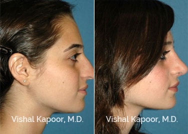 Patient 11 Side View Revision Rhinoplasty Beverly Hills Cosmetic Plastic Surgery Doc