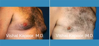 Patient 05 3/4 View Male Breast Reduction Beverly Hills Cosmetic Plastic Surgery Doc