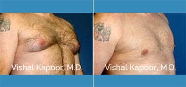 Patient 06 3/4 View Male Breast Reduction Beverly Hills Cosmetic Plastic Surgery Doc